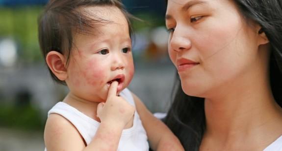 Wysypka na twarzy - objaw alergii lub groźnej choroby zakaźnej u dzieci i dorosłych