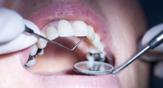 Stan zapalny zębów – dlaczego jest niebezpieczny dla zdrowia?