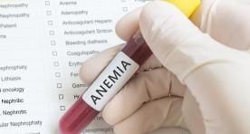 Anemia sierpowata (niedokrwistość sierpowatokrwinkowa): przyczyny, objawy i leczenie